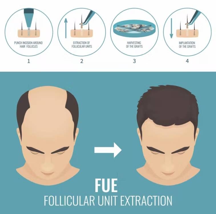 Fue Haar implantat Mikro motor – Hair Care Nutrition Bewertung und Preis